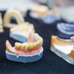 dental-implants-coburg